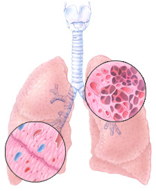 Emphysema